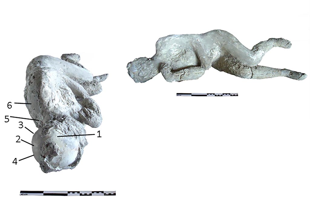 Victim 54. Two views of cast #54 and pXRF measuring points (1–6).
Photo courtesy of The Casts of Pompeii Project. Use subject to CC BY 4.0 Deed 
The cast #54 was identified as a female adult (35–40 years). 
This individual was found in a left lateral decubitus position, with the head resting on the left temporal parietal, the right arm with the elbow fully flexed and the forearm next to the chest.
No obvious pathological conditions in the individual #54 from Porta Nola, were observed
See Alapont L, Gallello G, Martinón-Torres M, Osanna M, Amoretti V, Chenery S, et al. (2023) The casts of Pompeii: Post-depositional methodological insights. PLoS ONE 18(8): e0289378, (Fig 6). https://doi.org/10.1371/journal.pone.0289378

